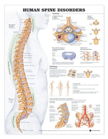 Anatomical Chart Spine Disorders 20 X 26 Inch Heavy Paper Grommets Laminated