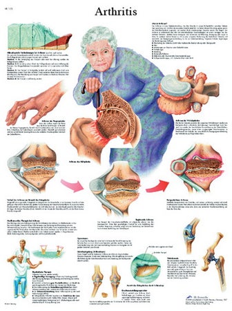 Anatomical Chart Arthritis 20 X 26 Inch Laminated