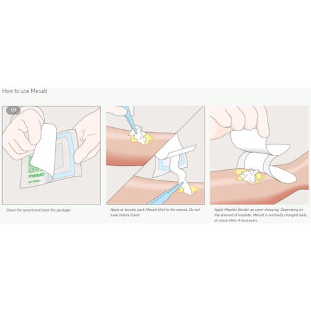 Sodium Chloride Impregnated Dressing Mesalt® Ribbon 3/4 X 39 Inch Sterile