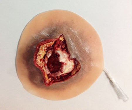 Moulage Open Humerus Fracture Plastic
