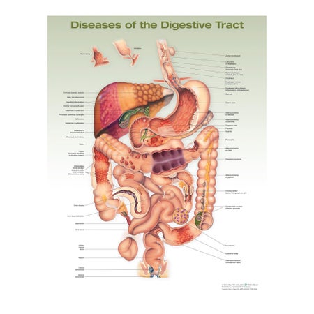 Anatomical Chart Diseases of the Digestive System, 2nd Edition 20 X 26 Inch Heavy Paper Frame / Hang Laminated