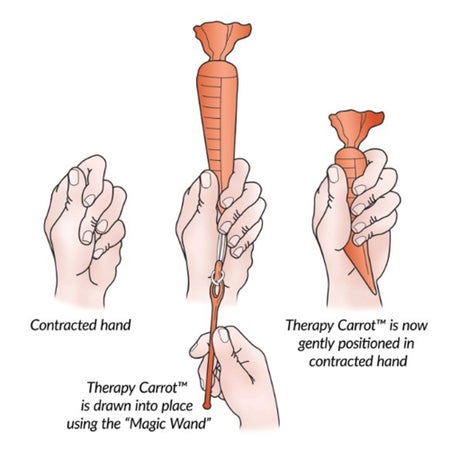 Finger Contracture Orthosis Kit Alimed® Original Therapy Carrot™ Adult Small Without Fastening Orange