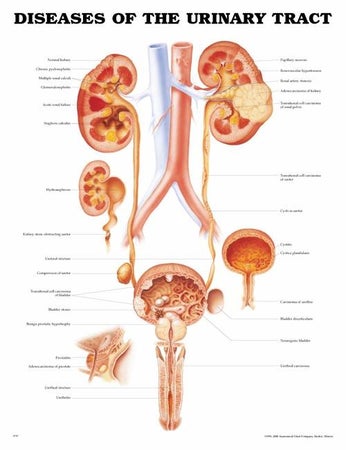 Anatomical Chart Diseases of the Urinary Tract 20 X 26 Inch Plastic Grommets Laminated