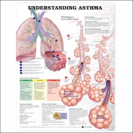 Chart Understanding Asthma 20 X 26 Inch Paper Laminated