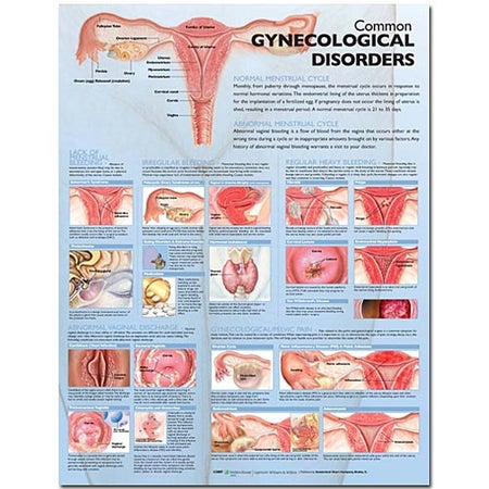 Anatomical Chart Common Gynecological Disorders 20 X 26 Inch Paper Grommets Laminated
