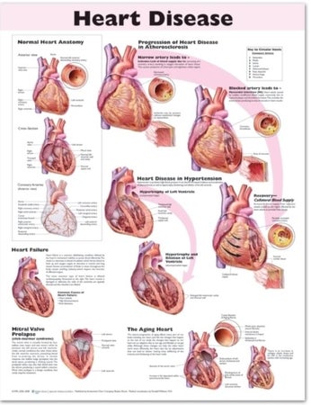 Anatomical Chart Heart Disease 20 X 26 Inch Heavy Paper Grommets Laminated