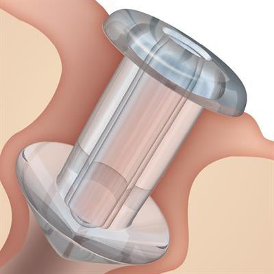 Punctum Plug Soft Plug® 0.8mm, Medium, Silicone, Not Made with Natural Rubber Latex