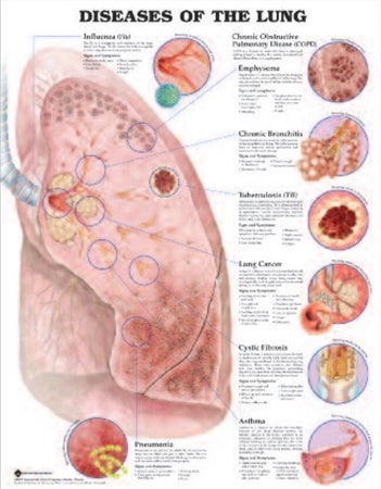 Anatomical Chart Lung Diseases 20 X 26 Inch Heavy Paper Grommets Laminated