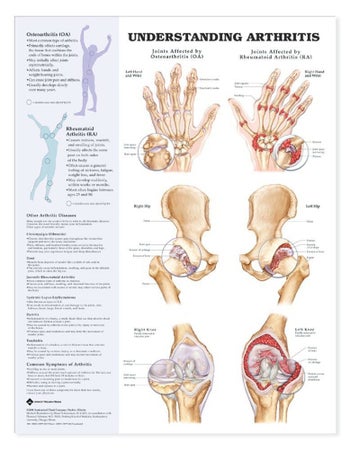 Anatomical Chart Arthritis 20 X 26 Inch Heavy Paper Grommets Laminated
