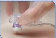 Micro Safety Needle Gripper® 20 Gauge 1-1/4 Inch Without Port