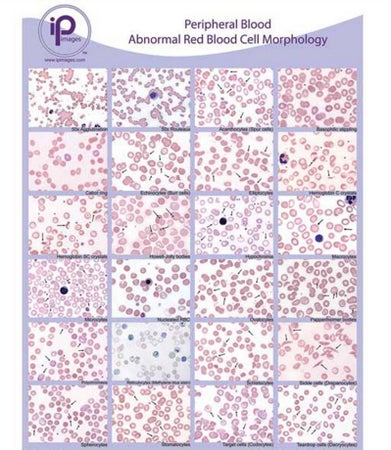 Anatomical Chart Blood Abnormal Red Blood Cell (RBC) Morphology Laminated