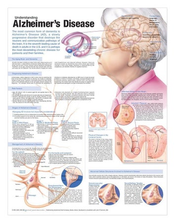 Anatomical Chart Alzheimer's Disease 20 X 26 Inch Heavy Paper Grommets Laminated